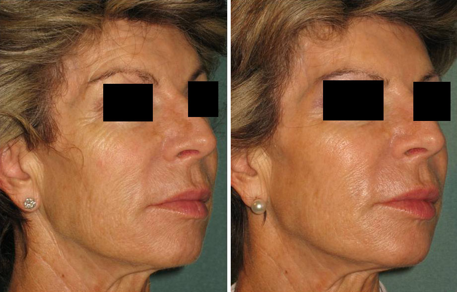Injections Sculptra Et Radiesse Nice Villabianca