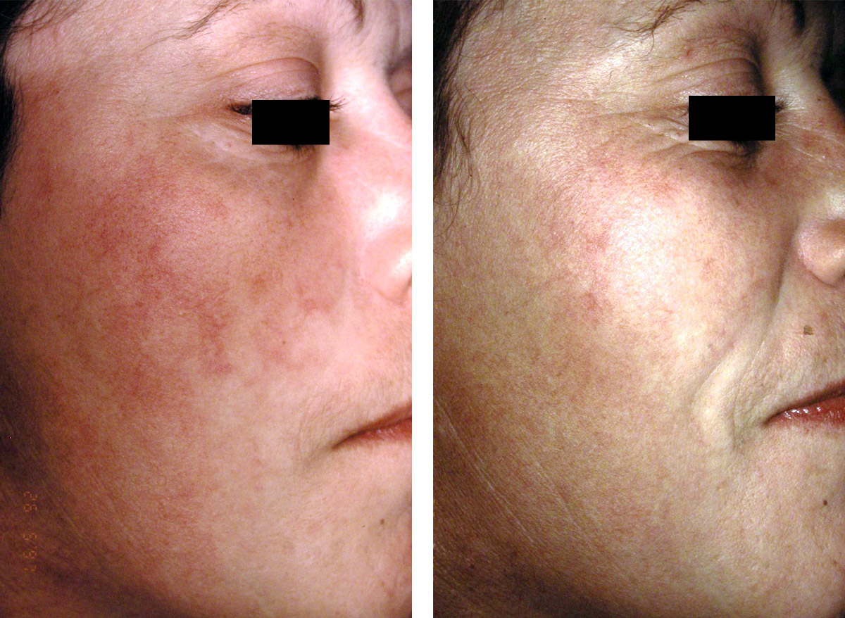 Photo avant / après traitement des rougeurs du visage au laser vasculaire Cynergy