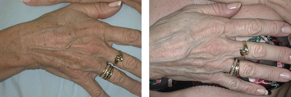 Photo avant après traitement des taches pigmentaires sur les mains