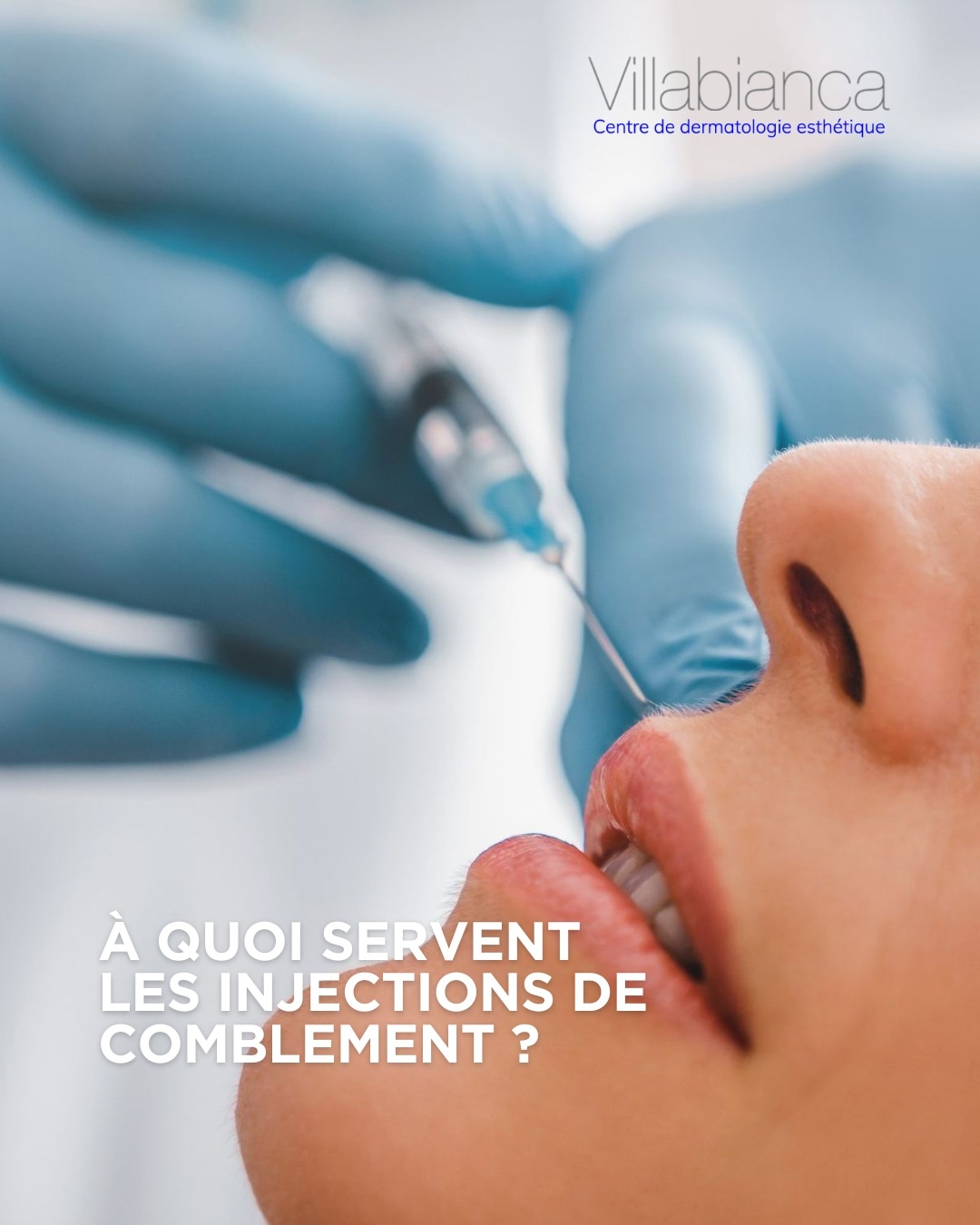 À quoi servent les injections de comblement ?