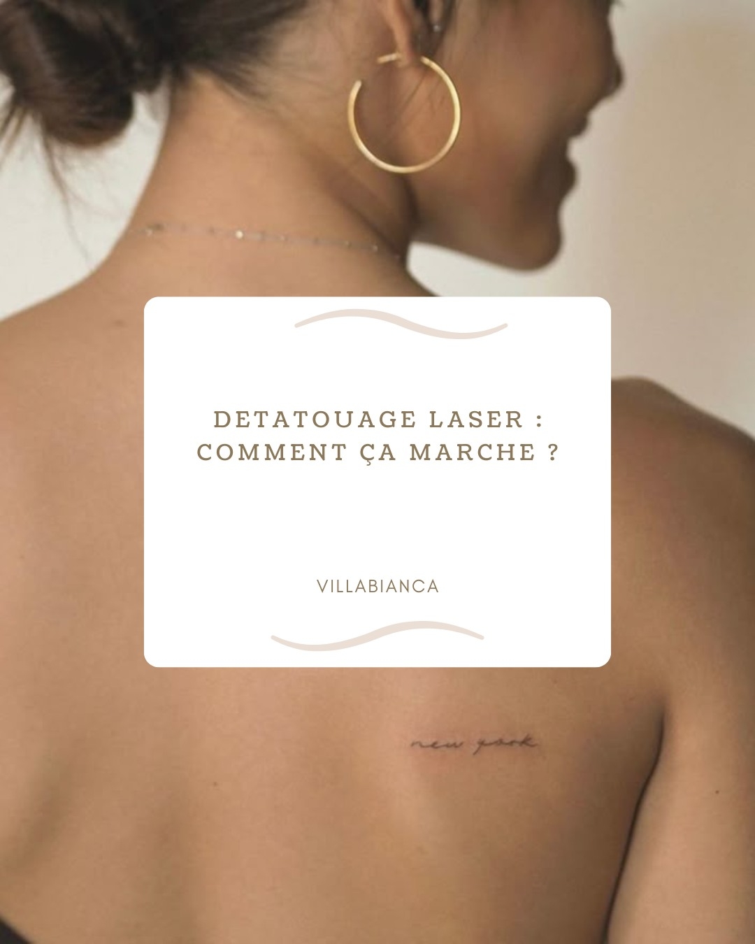 Détatouage laser : comment ça marche