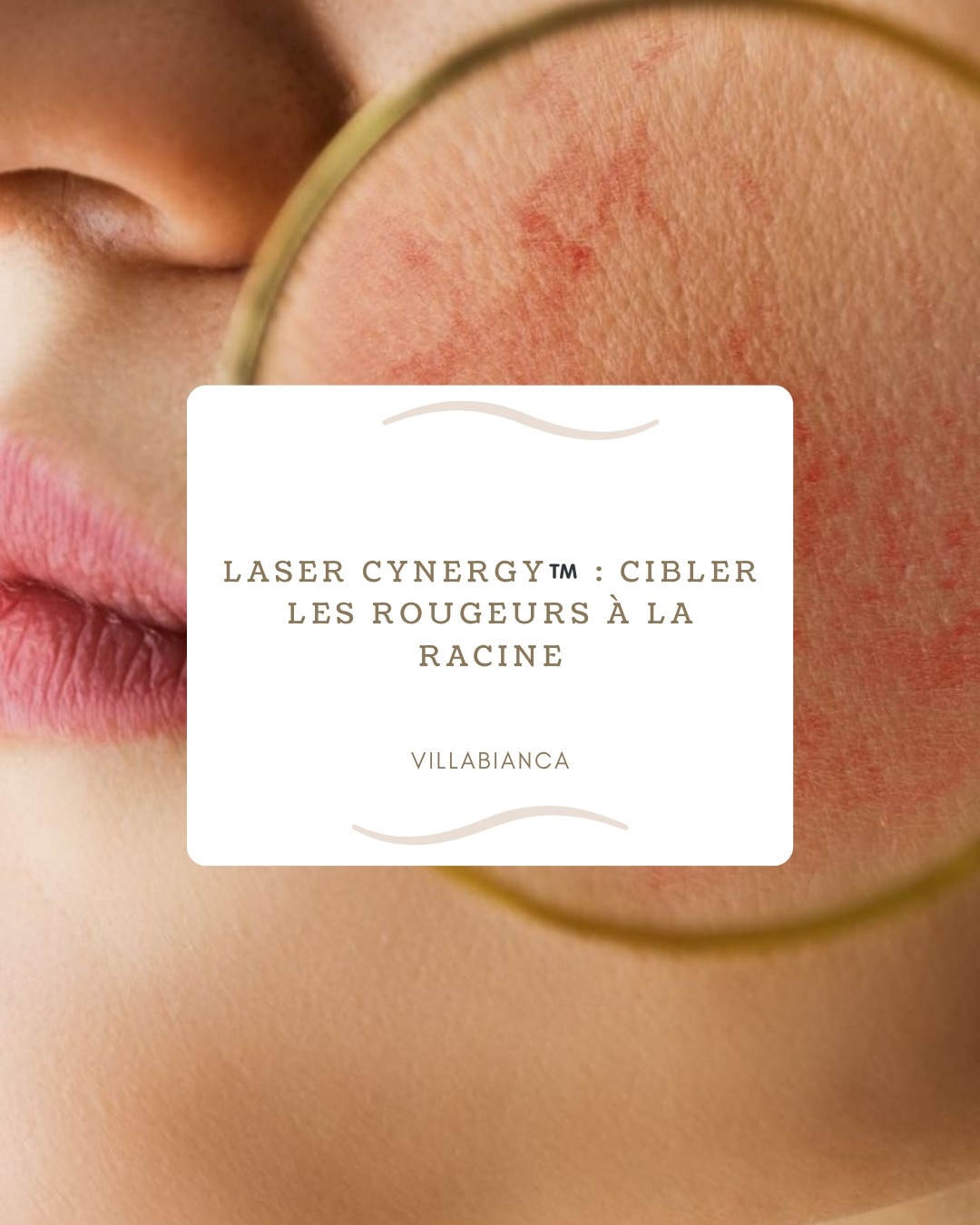 Laser cynergy : cibler les rougeurs à la racine