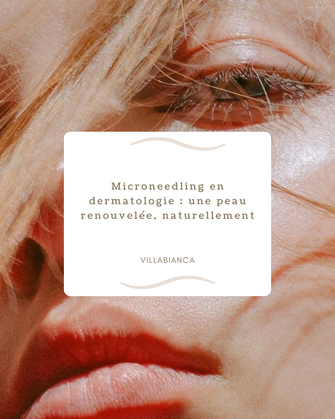 Microneedling en dermatologie : une peau renouvelée, naturellement.